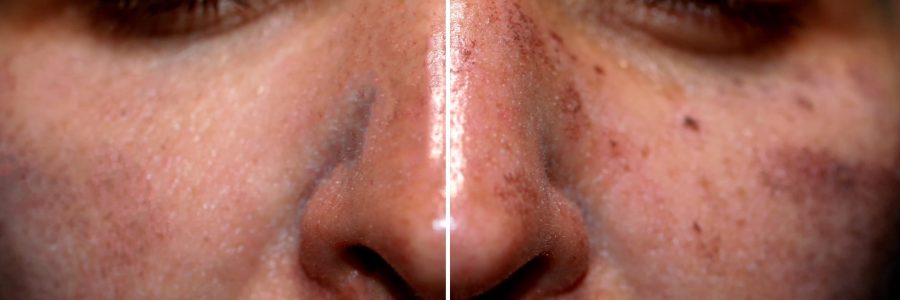 One half of the face in pigmentation and brown spots, the other side of the face after laser polishing and peeling.
